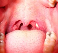 angina-posle-antibiotikov-7.jpg